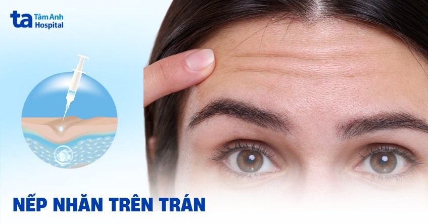 nếp nhăn trên trán