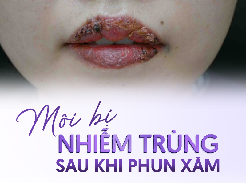 bảng giá phun môi collagen