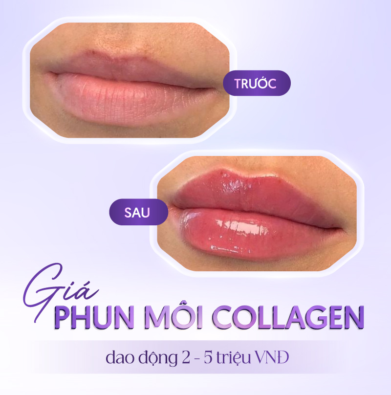 phun môi collagen linh anh