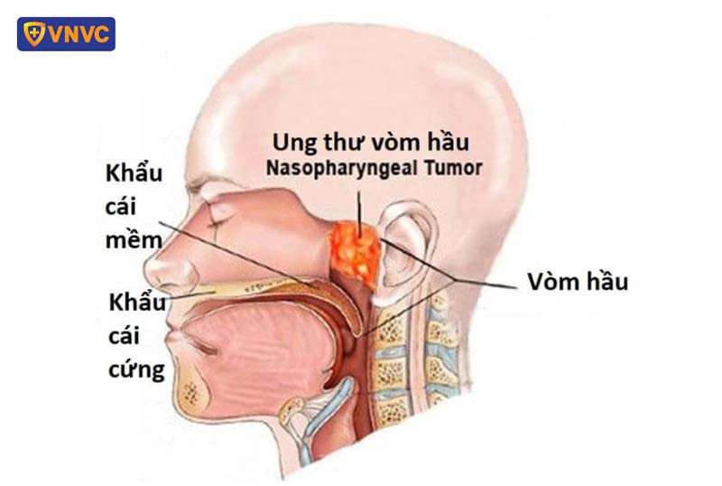 ảnh giải phẫu ung thư vòm họng giai đoạn 2