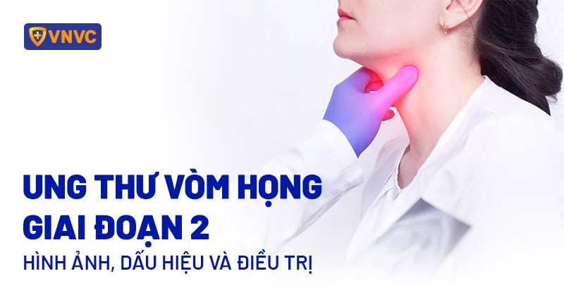 ung thư vòm họng giai đoạn 2