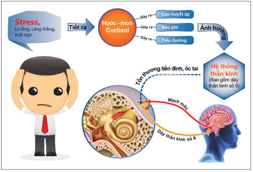 Căng thẳng, stress có thể gây rối loạn tiền đình