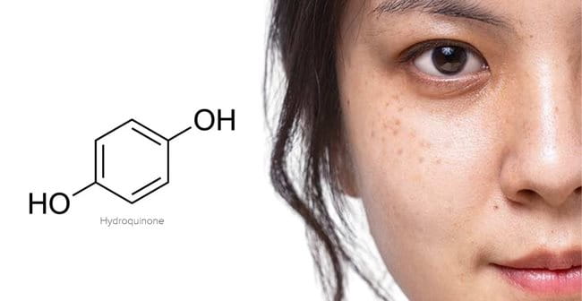 Cách làm trắng da với Hydroquinone