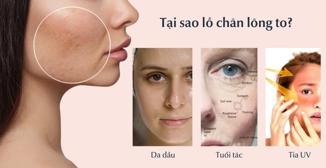 Tại sao lỗ chân lông to?