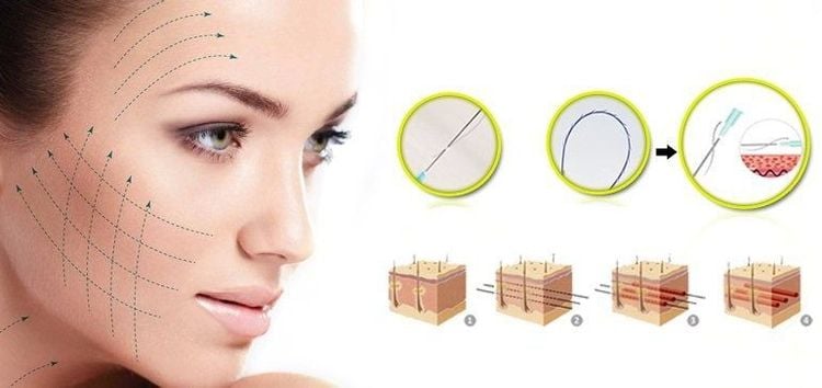 Căng chỉ collagen có an toàn không là thắc mắc của nhiều chị em