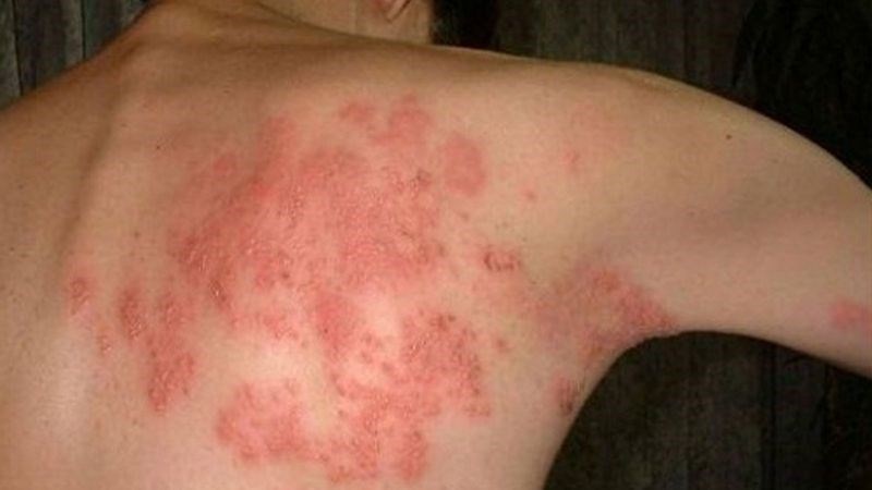 Bệnh zona thần kinh là một bệnh nhiễm trùng do virus Varicella-zoster gây ra