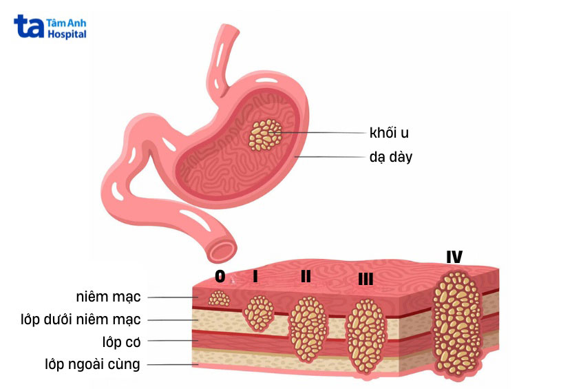 khối u ung thư dạ dày qua từng giai đoạn