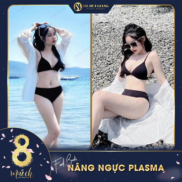 Kết quả khách hàng nâng ngực plasma