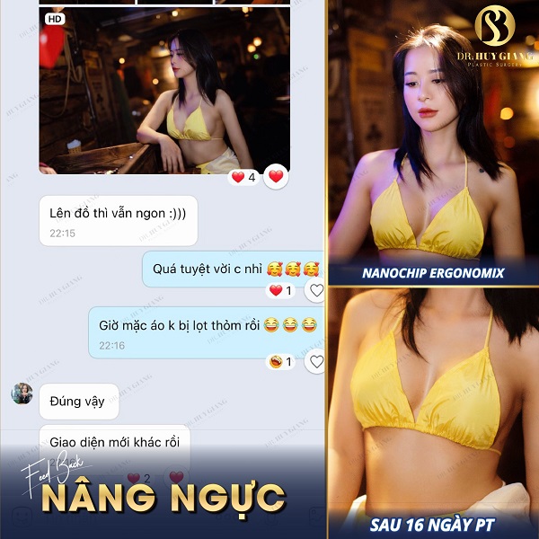 Feedback nâng ngực sau