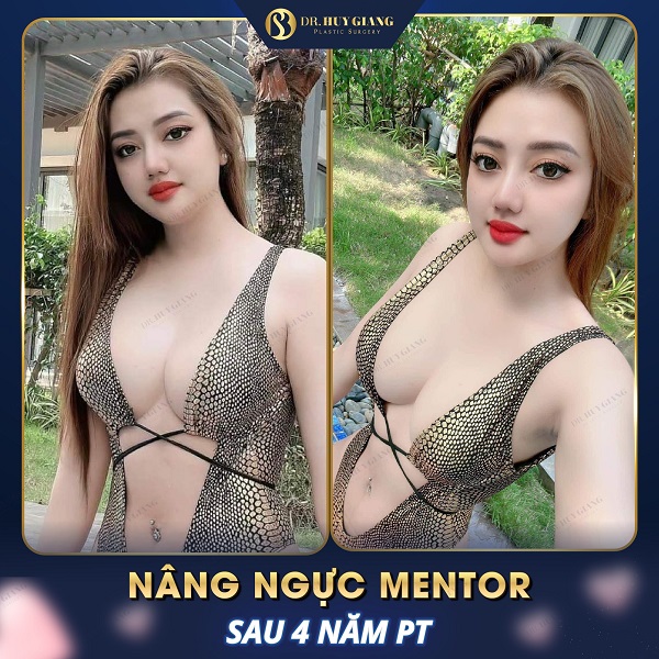 Kết quả nâng ngực sau 4 năm