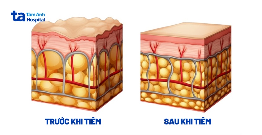 bề mặt da trước và sau tiêm filler