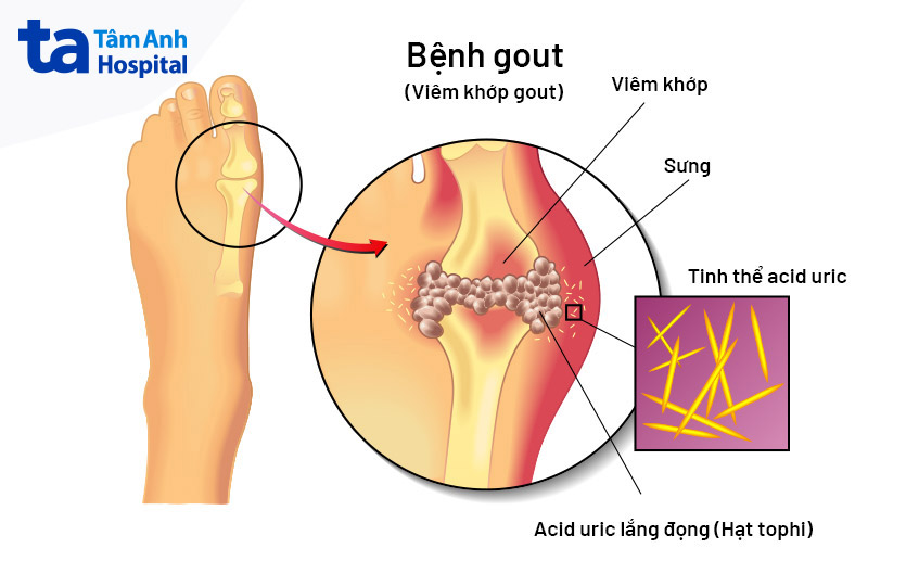 bệnh gây nhiều đau đớn cho người bệnh