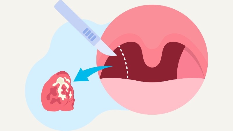 Phẫu thuật điều trị ung thư amidan nhằm loại bỏ càng nhiều tế bào ung thư càng tốt