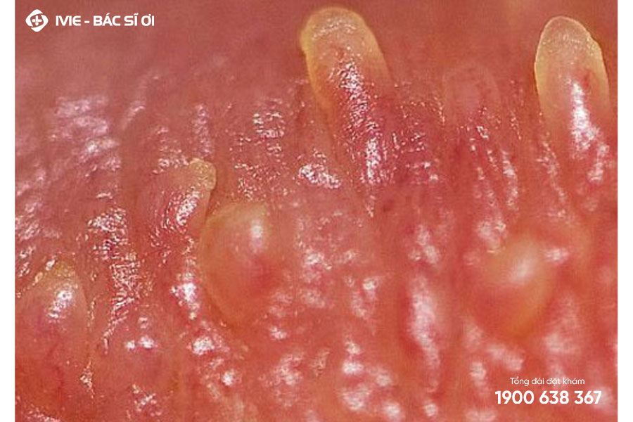 Các mụn thịt của bệnh u nhú tiền đình Papillomatosis