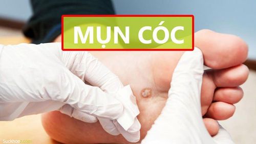 Điều trị cắt bỏ mụn cóc tại cơ sở y tế