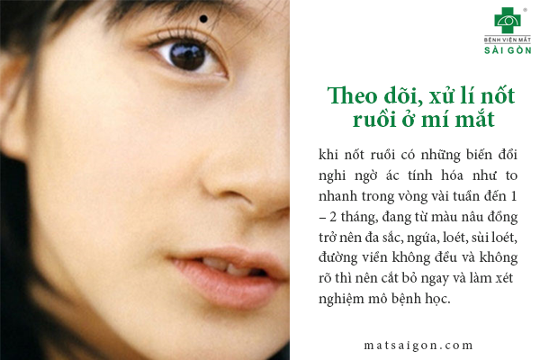 nốt ruồi ở mi mắt