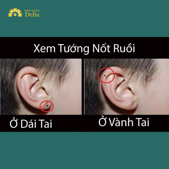 Nốt ruồi ở tai nam, nữ: Ý nghĩa, vận mệnh theo nhân tướng học