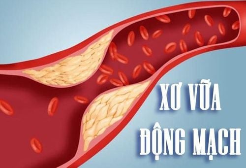 Tăng huyết áp tâm thu đơn độc gây lên xơ vữa động mạch