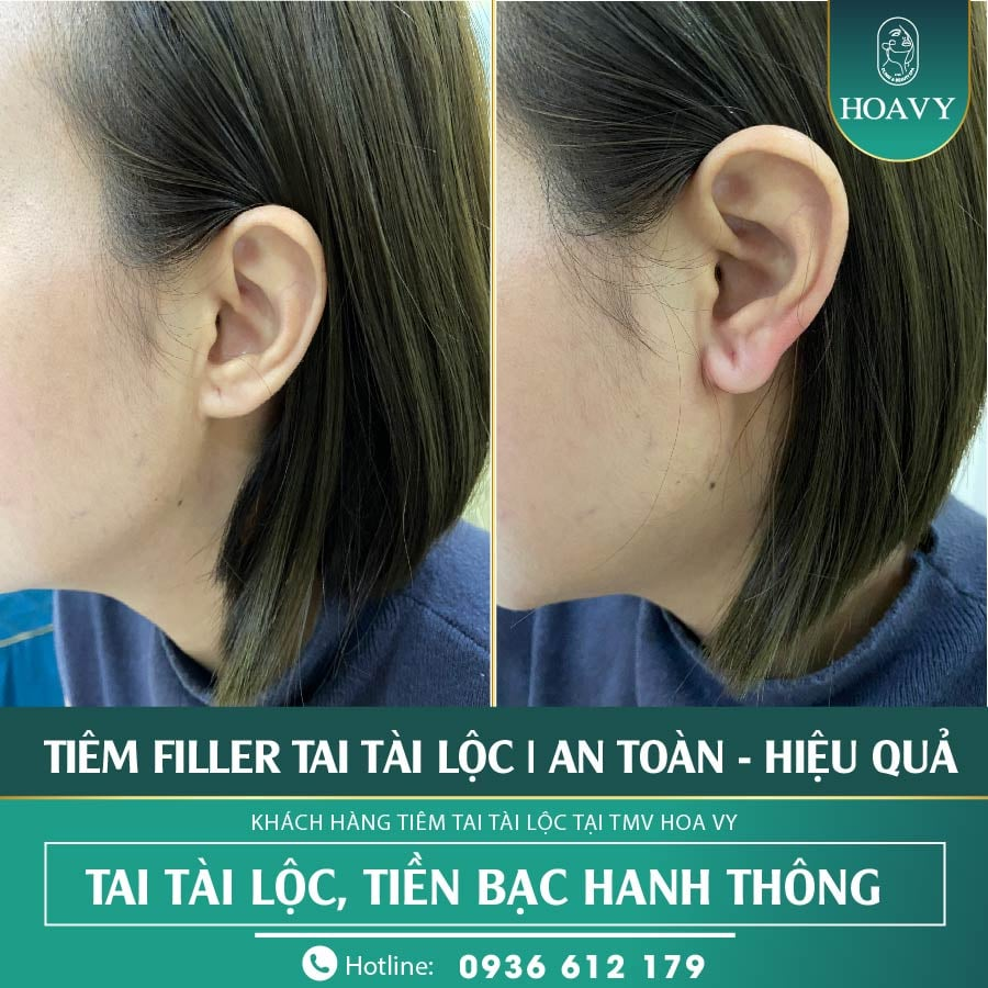 Tiêm tai tài lộc có quy trình thăm khám, tư vấn và tiến hành rõ ràng