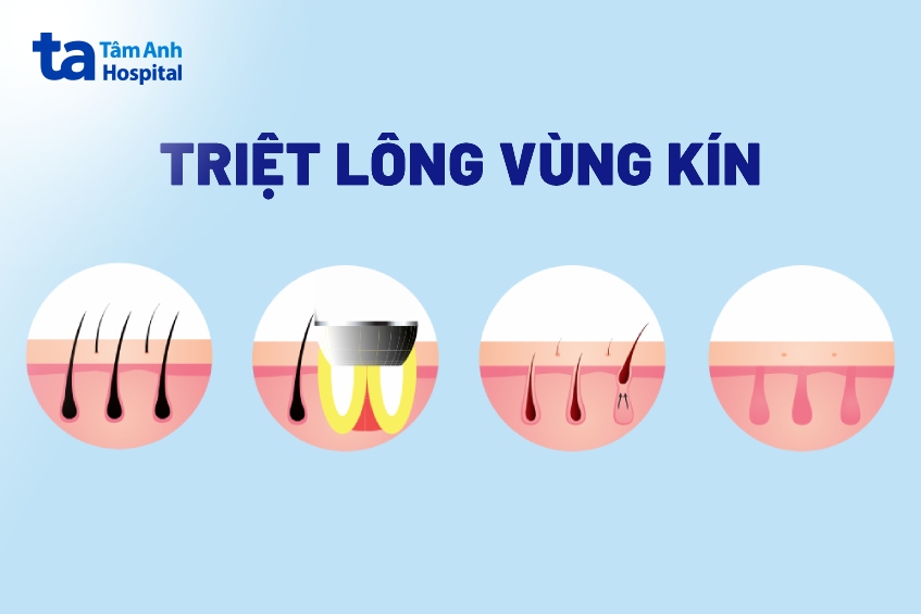 phương pháp triệt lông vùng kín