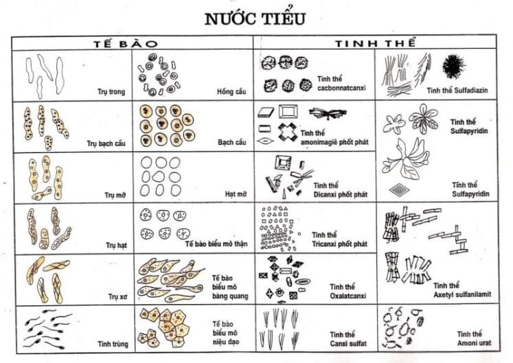 Các thành phần hữu hình quan sát được trong soi cặn nước tiểu