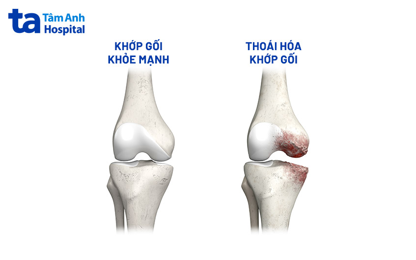 bệnh lý thường gặp ở khớp