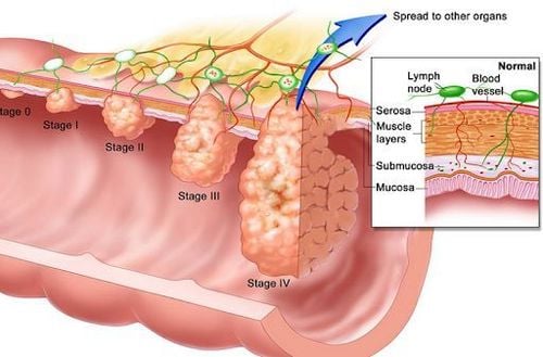 Biến chứng có thể gặp sau khi phẫu thuật ung thư đại tràng, trực tràng