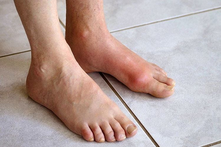 Bệnh gout là một trong số các bệnh về khớp thường gặp