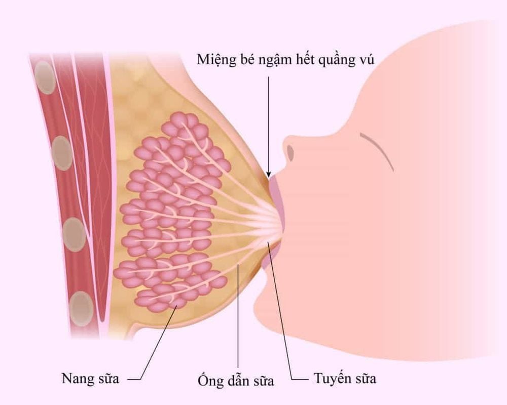 Tắc ống dẫn sữa có thể gây viêm vú