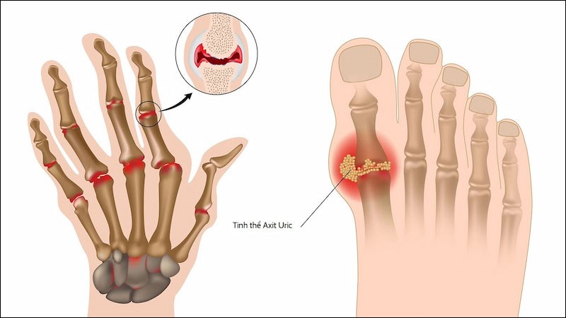 Cây xuyến chi mang lại hiệu quả chống viêm tốt, nhất là ở bệnh nhân gout