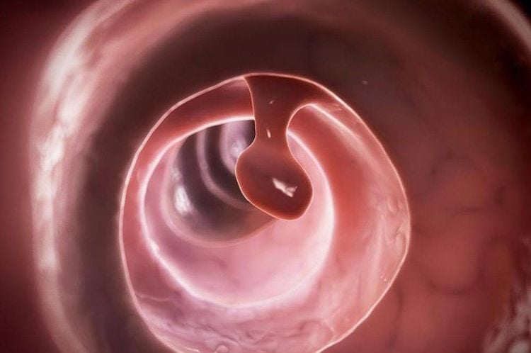 Khả năng tiến triển thành ung thư đại tràng của polyp đại tràng ít hơn so với các polyp đại tràng khác