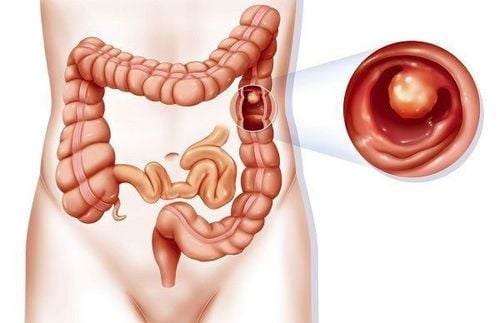 Polyp đại tràng có thể tiến triển thành ung thư đại tràng