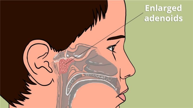 Vị trí adenoids