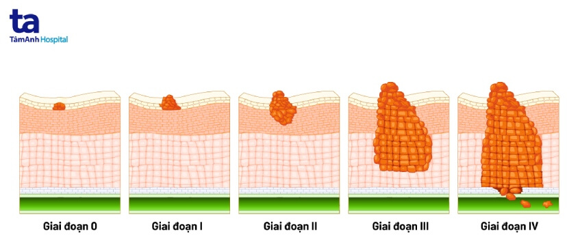 5 giai đoạn ung thư đại tràng