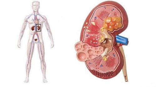 Tăng acid uric trong máu có thể gây viêm thận kẽ