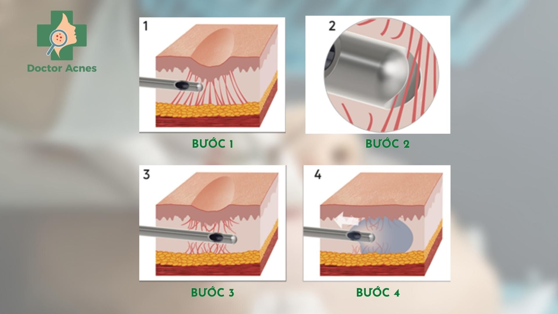 trị sẹo bằng phương pháp cannula