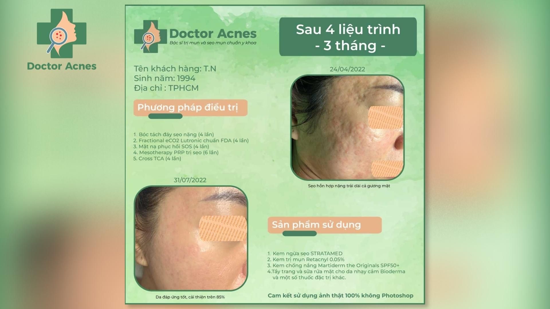 Bóc tách đáy sẹo bằng cannula tại phòng khám Doctor Acnes - Doctor Acnes