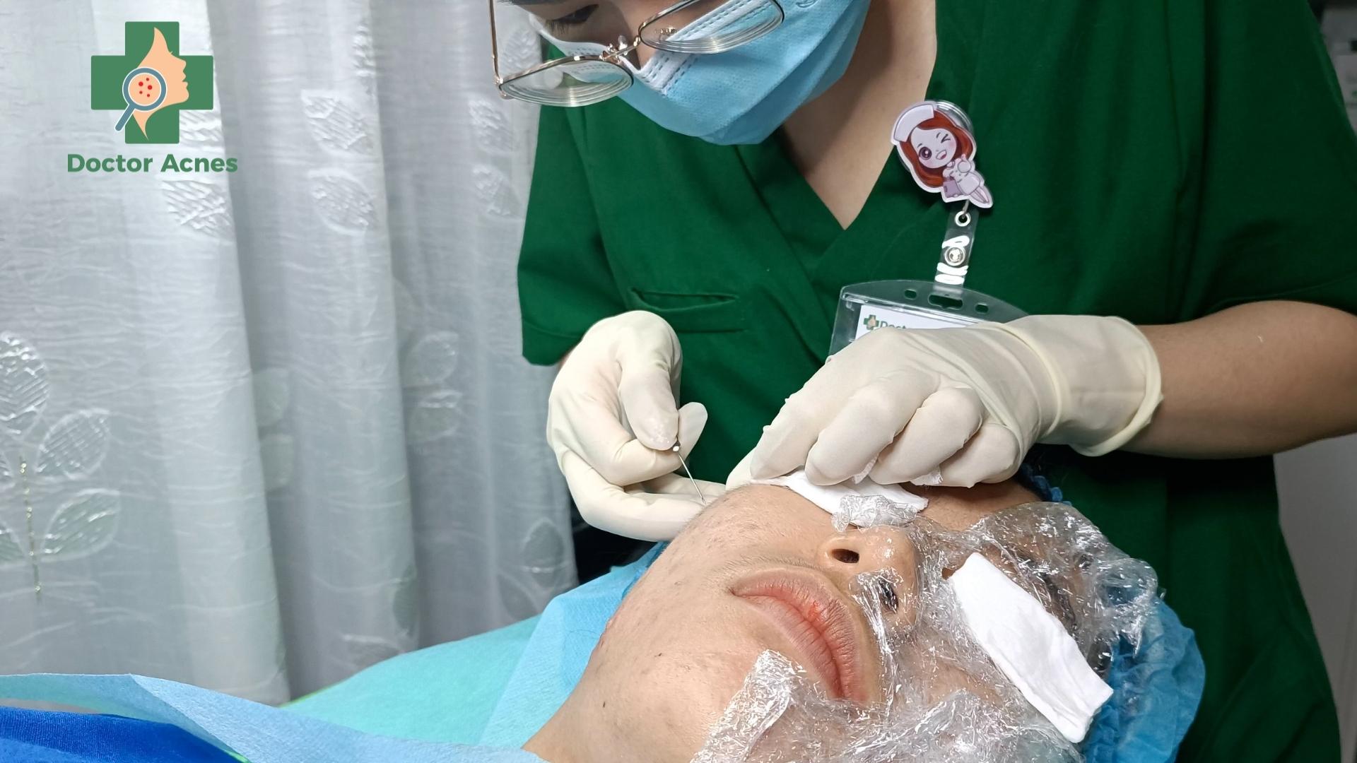 Bóc tách đáy sẹo bằng cannula do Bác sĩ Da liễu thực hiện - Doctor Acnes