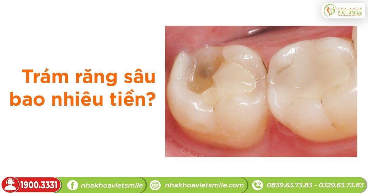 Trám răng sâu bao nhiêu tiền?