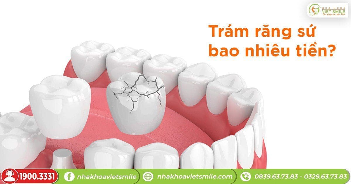 Trám răng sứ bao nhiêu tiền?