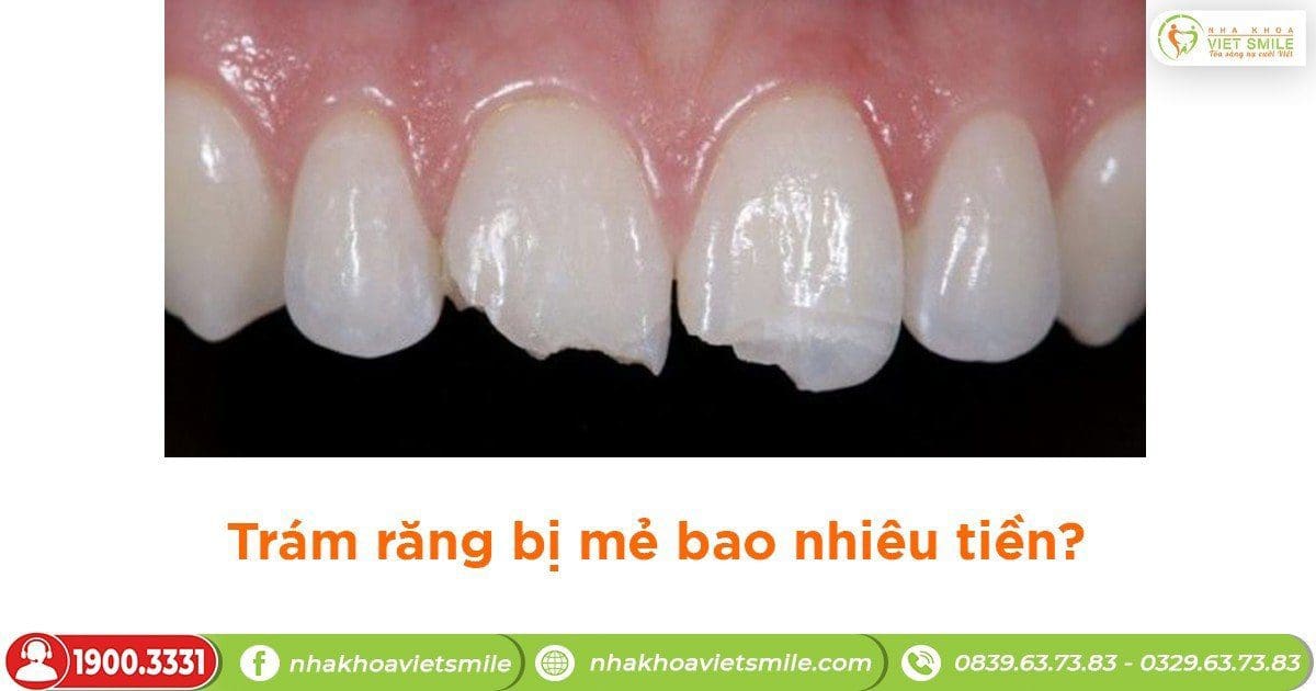 Trám răng bị mẻ bao nhiêu tiền?