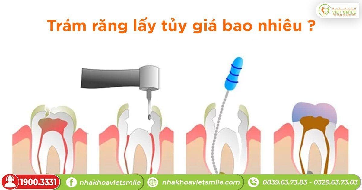 Trám răng lấy tủy giá bao nhiêu?