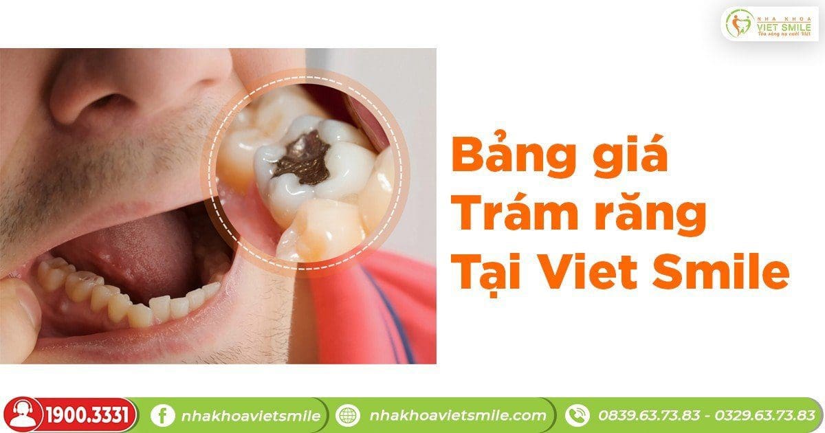 Bảng giá trám răng tại Việt Smile