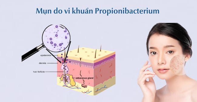 Nguyên nhân gây mụn hàng đầu - Vi khuẩn P.Acnes