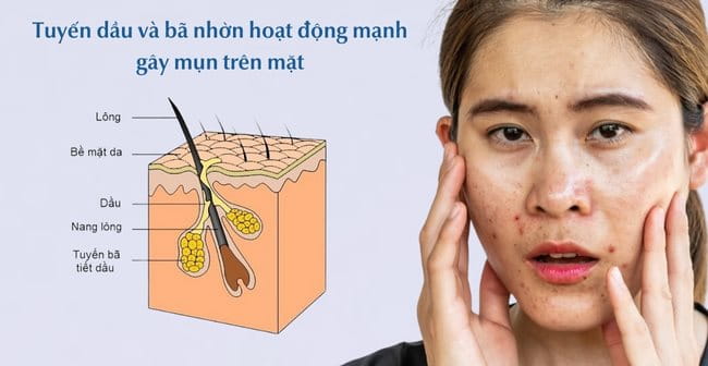 Tuyến dầu và bã nhờn hoạt động mạnh mẽ là nguyên nhân gây mụn