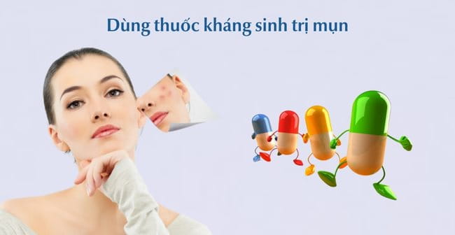 Uống thuốc kháng sinh cải thiện các loại mụn mức độ trung bình