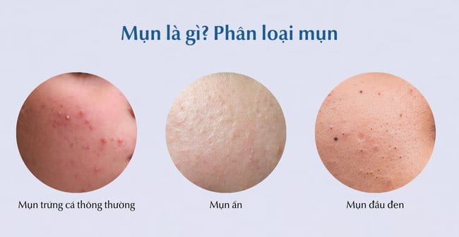 Mụn là gì? Phân loại mụn