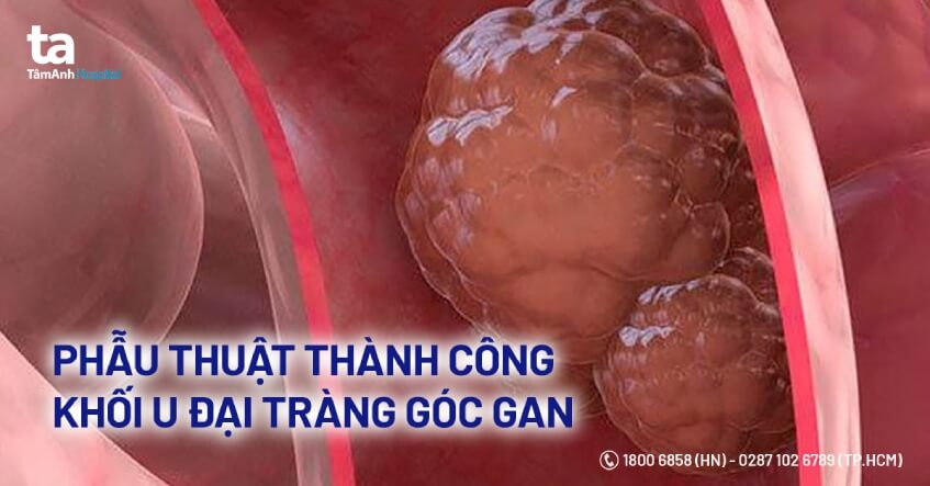 phẫu thuật thành công khối u đại tràng góc gan