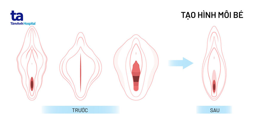 tạo hình của môi bé