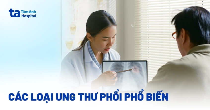 các loại ung thư phổi